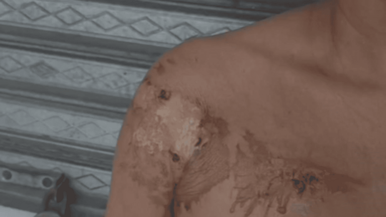 Mujer sufre quemaduras tras ser atacada con aceite caliente por presunta deuda en Moca