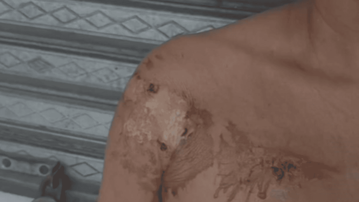 Mujer sufre quemaduras tras ser atacada con aceite caliente por presunta deuda en Moca